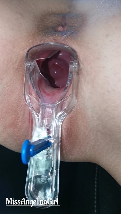 Examination of the cervix